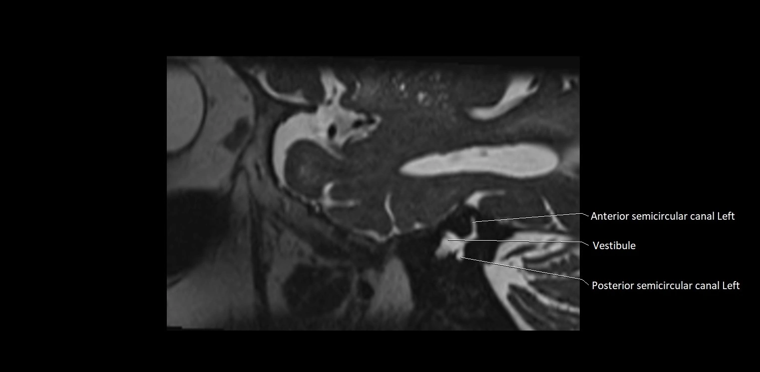Cranial nerve sagittal anatomy MRI 3T image 6.webp